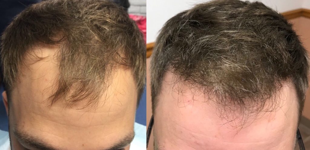 کاشت موی طبیعی قبل و بعد